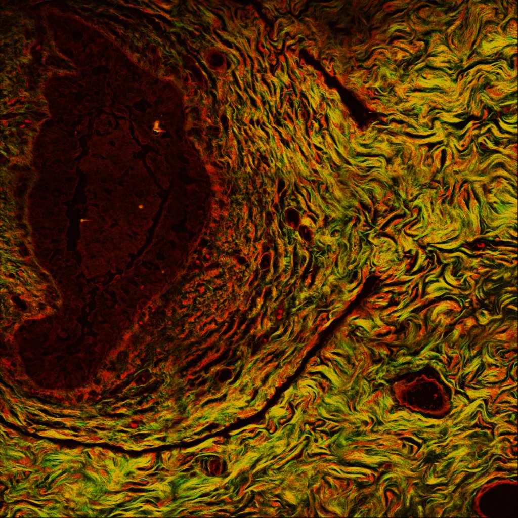 Second harmonic generation (SHG) image on a breast cancer section. Green: collagen; Red: nonspecific tissue
