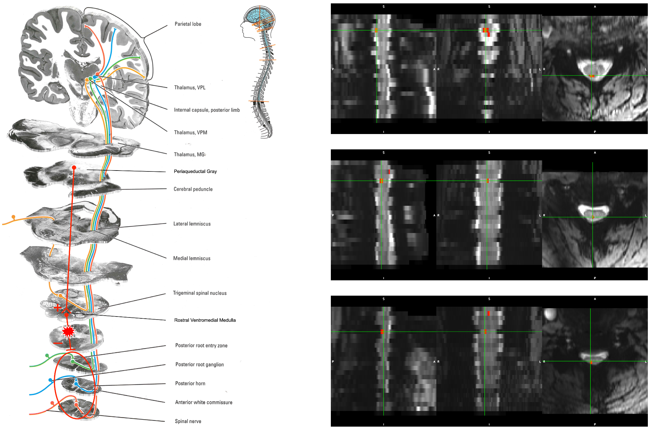 Thermal pain stimulus fMRI in the human spinal cord at 7 T